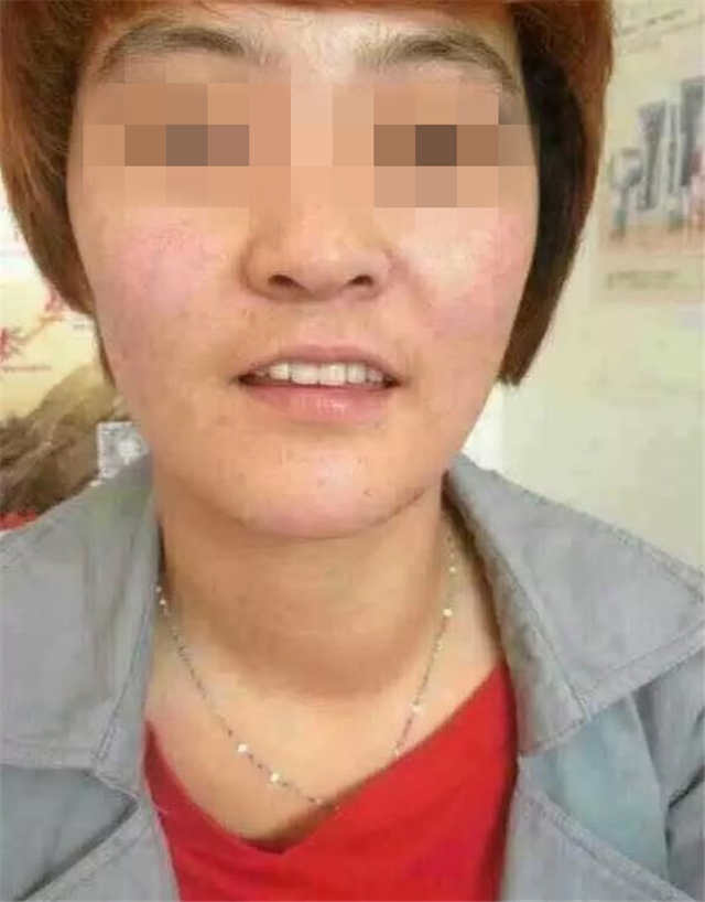 这位女士用增健 灵芝皇 钙片调理甲亢,不到3个月